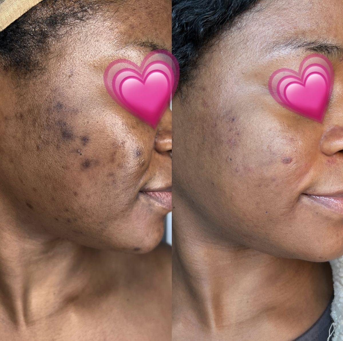Turmeric & Kojic Acid Face Cream